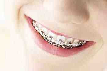How much is a cosmetic filling?