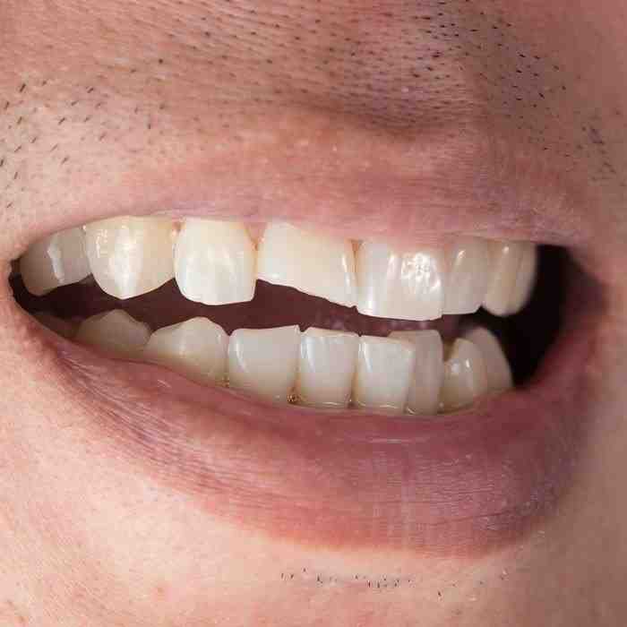 How much is a cosmetic filling?