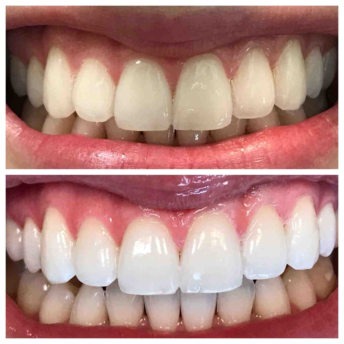 How much is a cosmetic filling?