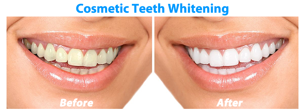How much is a cosmetic filling?