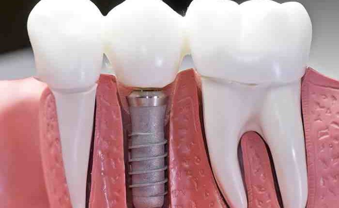 How much is a dental implant
