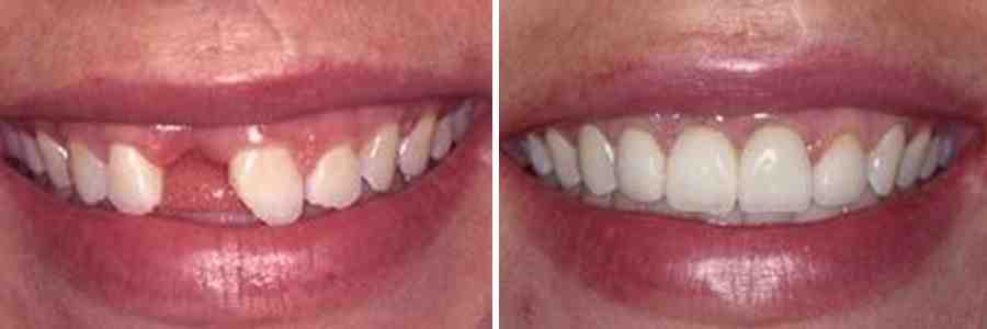 How much is a full set of dental implants?