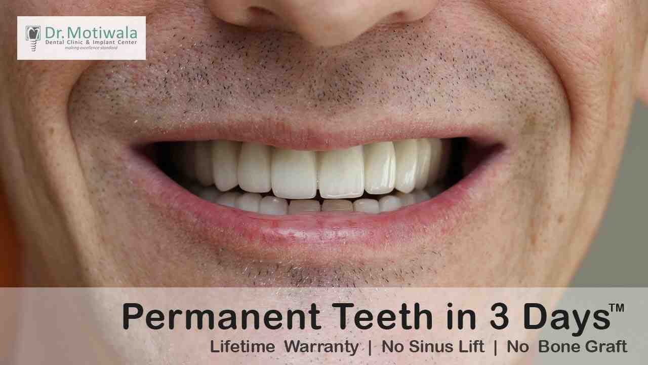 How much is a full top set of dental implants?