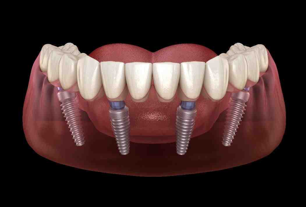 How much is a full top set of dental implants?