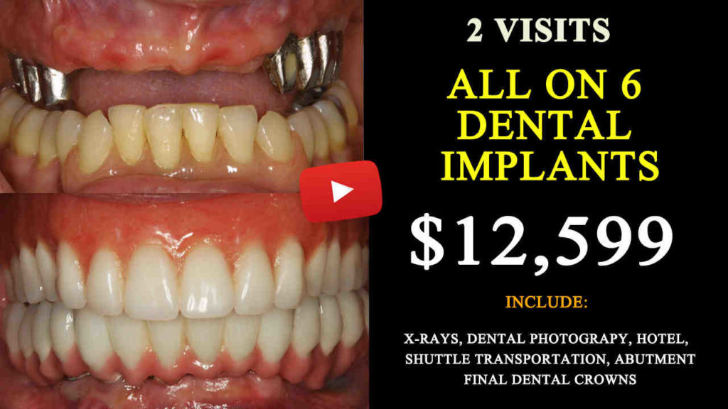 Where To Get Dental Implants And Cost Of Full Dental Implants Dental 