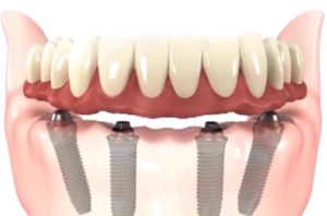 implant
