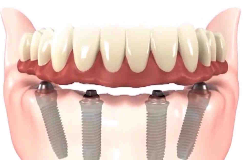 How much is an implant without insurance?