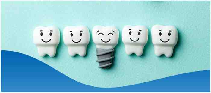 How much is dental implants in South Africa?