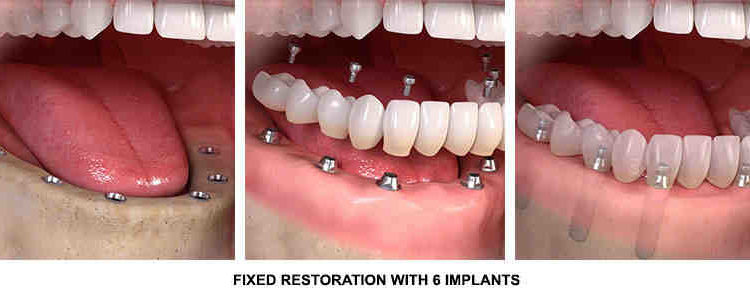 How much is one dental implant