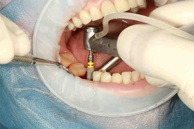 How much is tooth implant in Philippines?