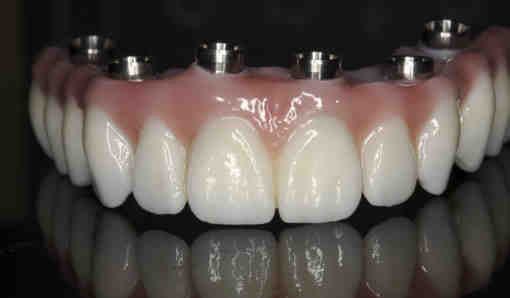 How much is tooth implant in Philippines?