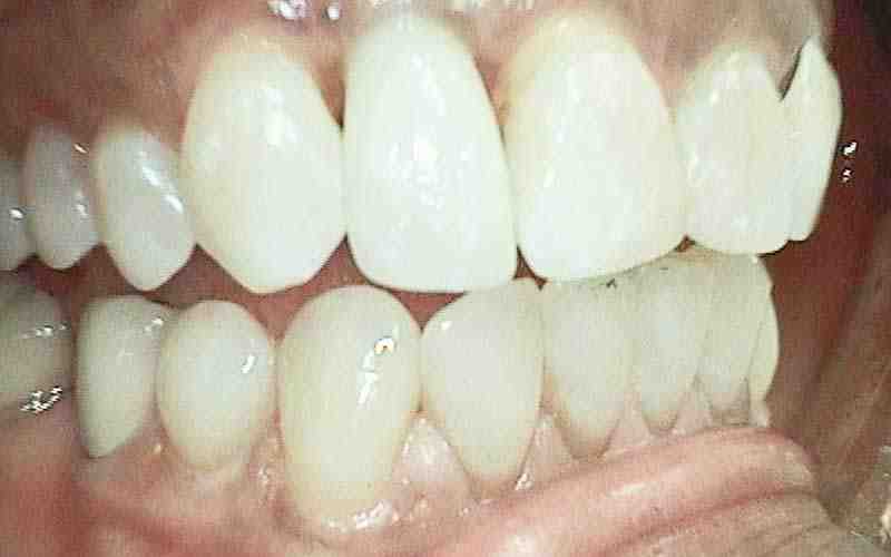 How much does a dental implant cost for one tooth? Dental News Network