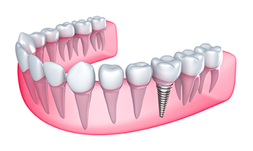 How much should dental implants cost in 2020?
