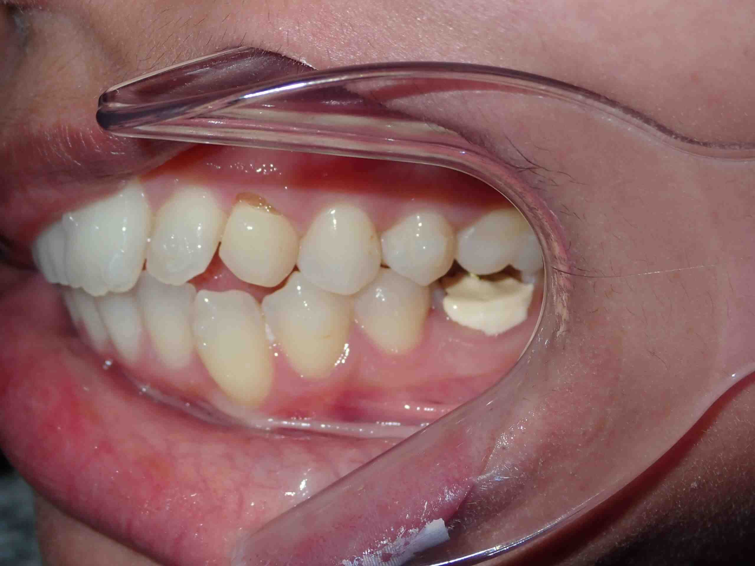 How much should dental implants cost in 2020?