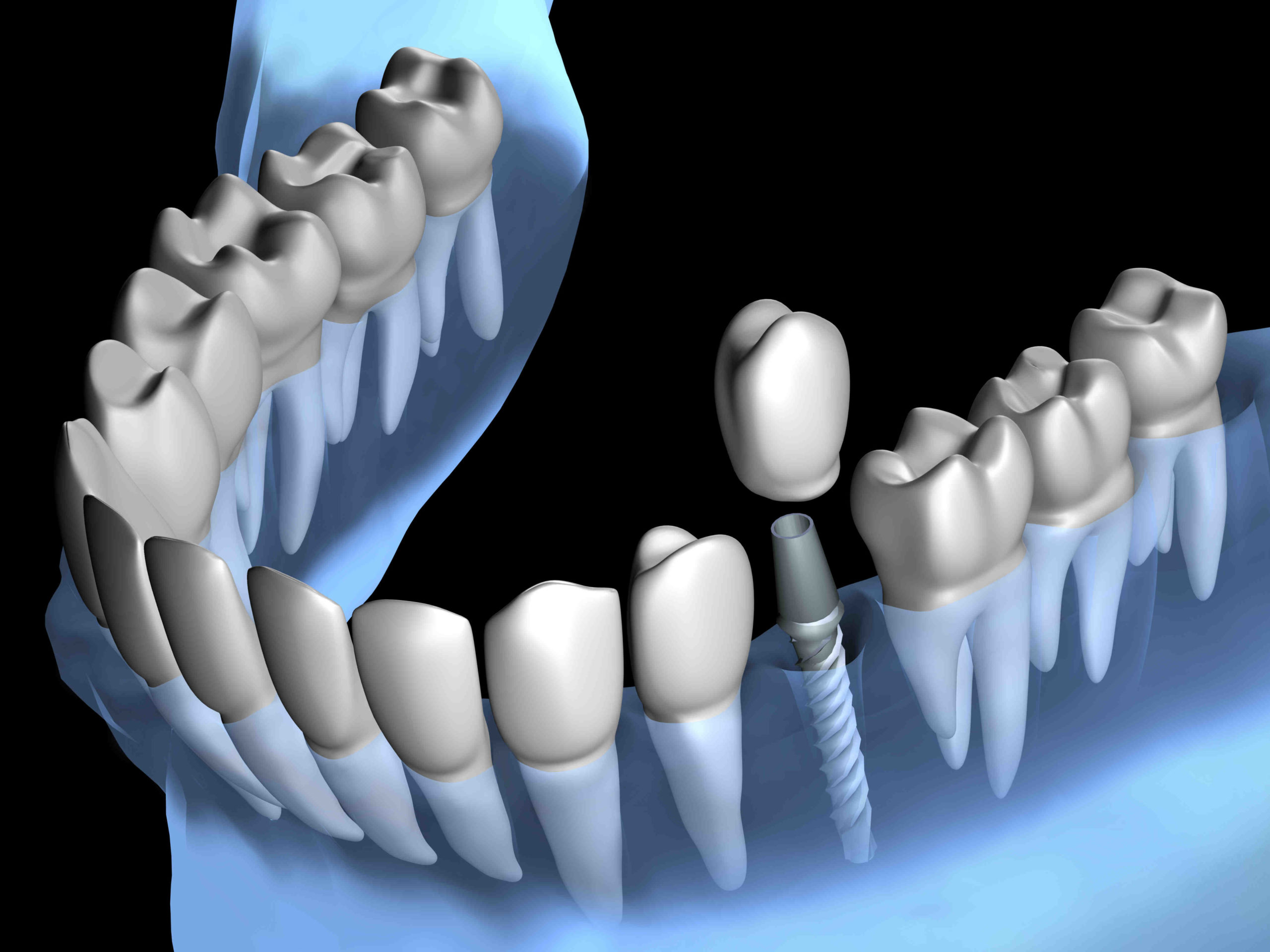 How much should dental implants cost in 2020?