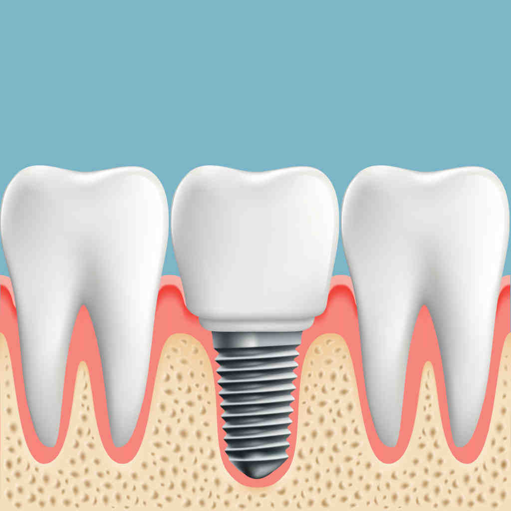 How much will dental implants cost in 2020?
