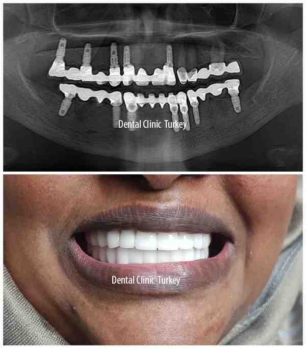 How much would it cost for a full mouth of dental implants?