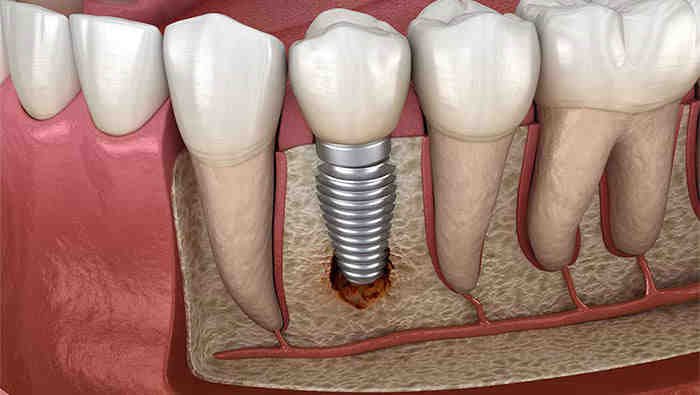 How painful is a dental implant?