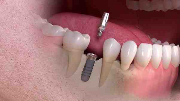 How painful is a dental implant?
