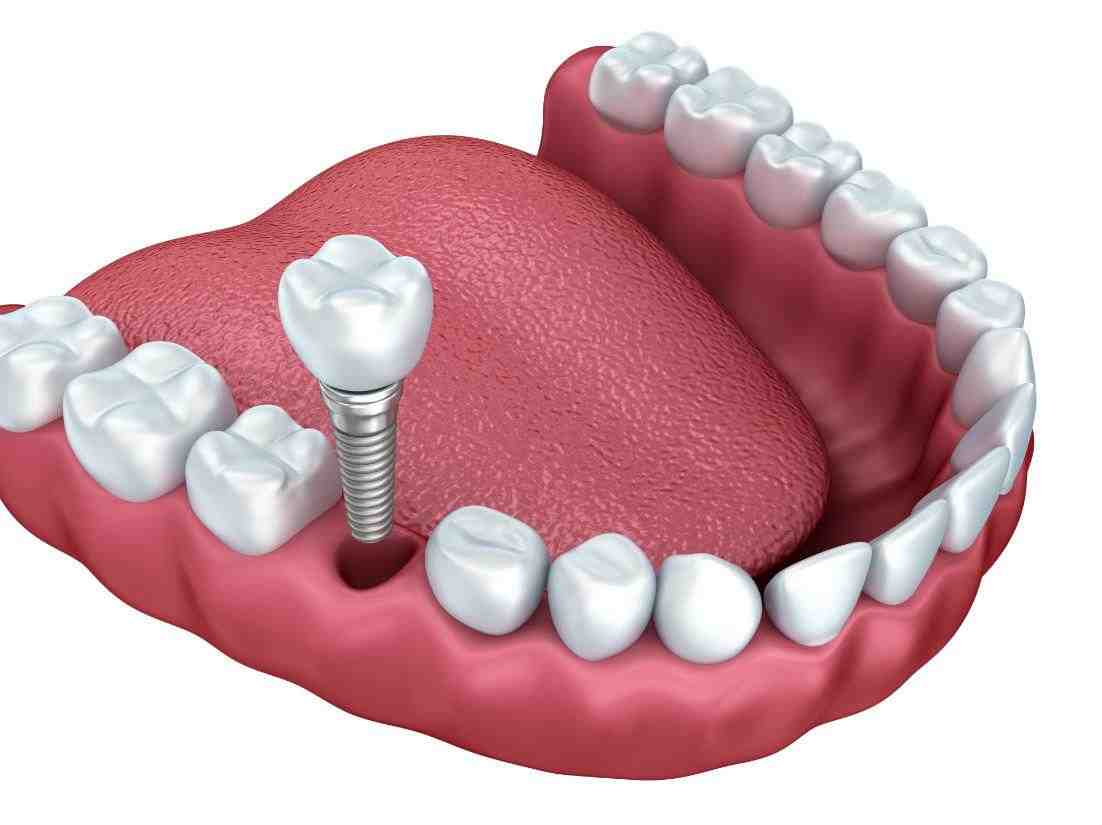 How painful is a dental implant?