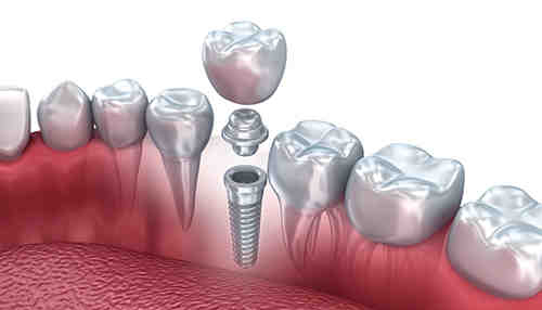How painful is a dental implant?