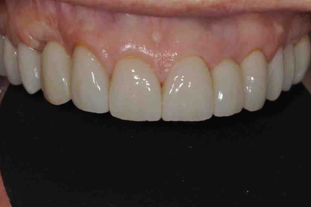 How painful is getting a dental implant?