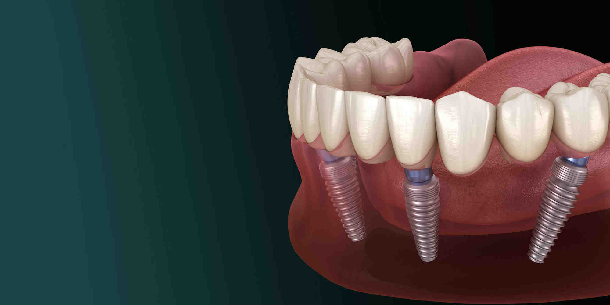 How long does a dental implant procedure take Dental News Network