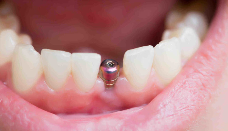 How to care for dental implants