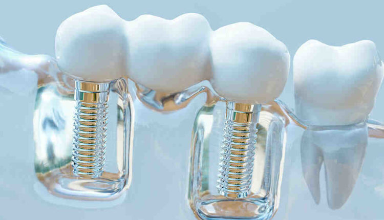 How to get financed for dental implants in east texas
