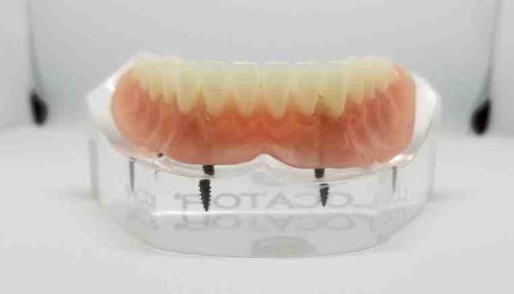 How to pay for dental implants with bad credit