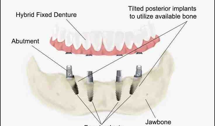 How to pay for dental implants without insurance