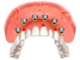 Is a tooth implant considered cosmetic?