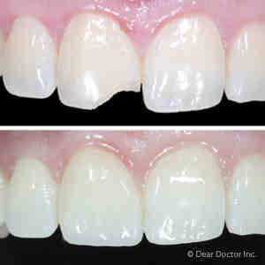 Is dental bonding available on the NHS?