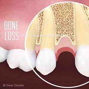 Is dental bonding free?