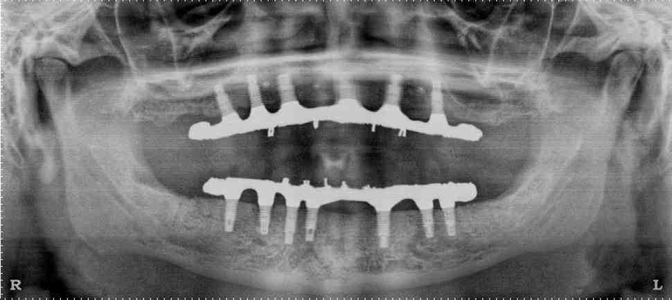 Is it safe to get dental implants in Mexico?