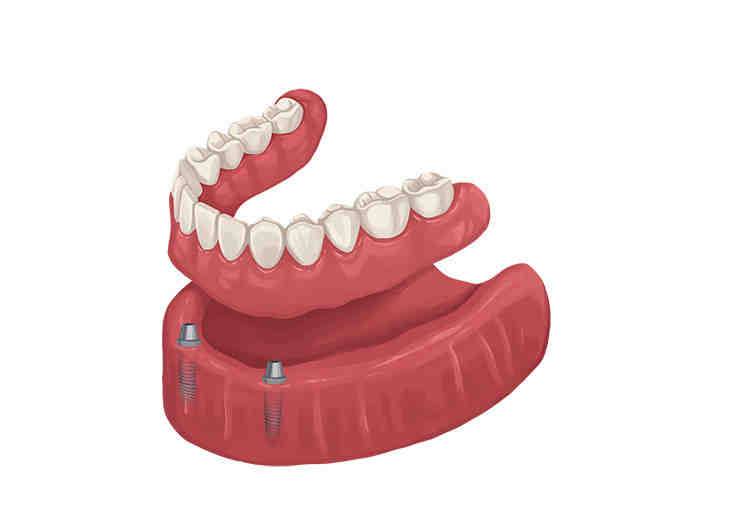 Is there a cheaper alternative to dental implants?