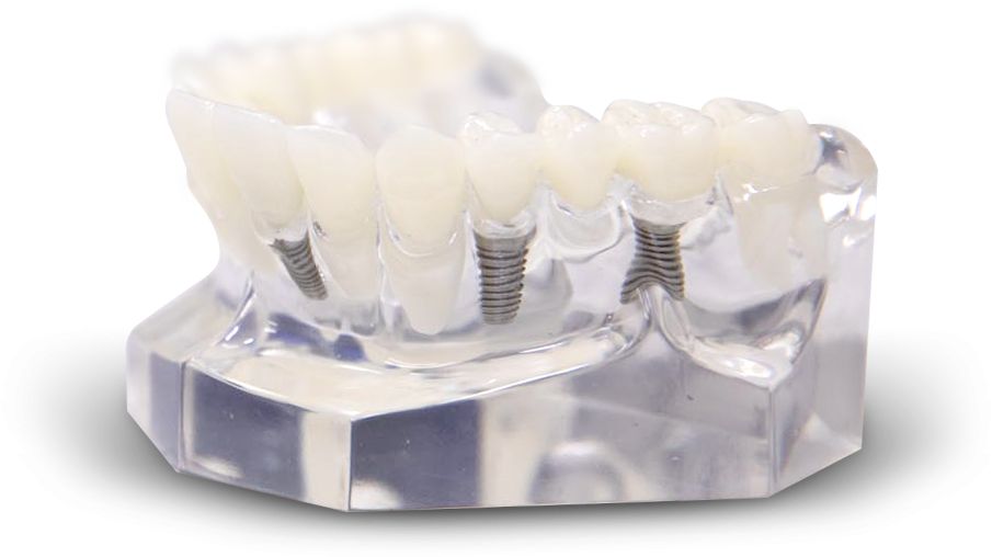 Is there a cheaper alternative to dental implants?