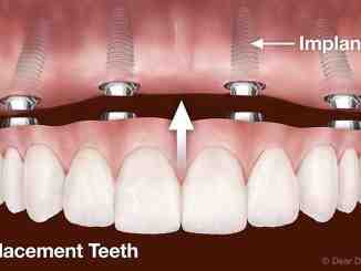 Is there any dental insurance that covers dental implants?