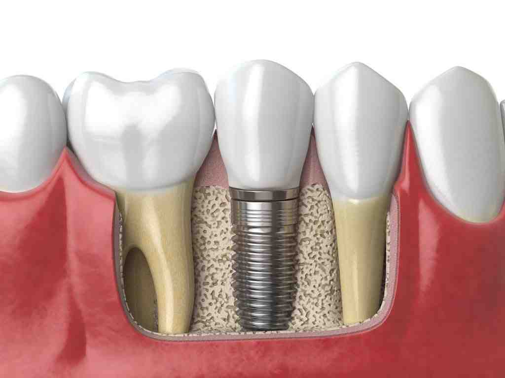 Are dental implants covered by insurance Dental News Network