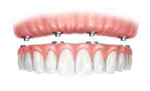 Is there any dental insurance that covers dental implants?