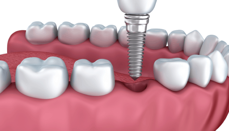 What are dental implants