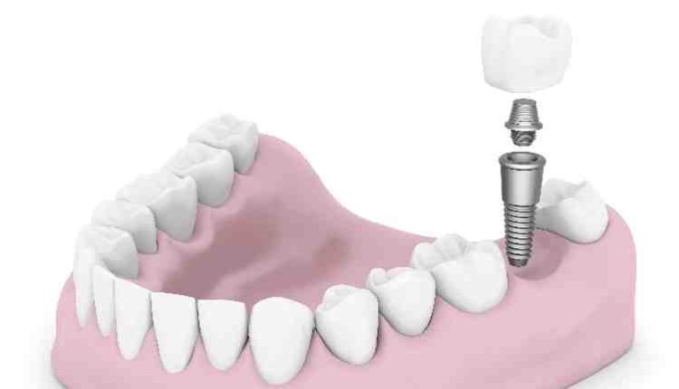 What are dental implants made of