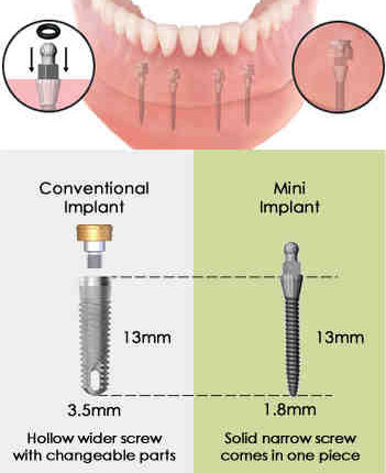 What are mini dental implants