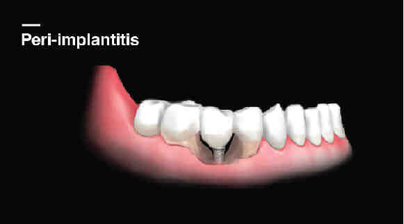What are the problems with all on 4 dental implants?