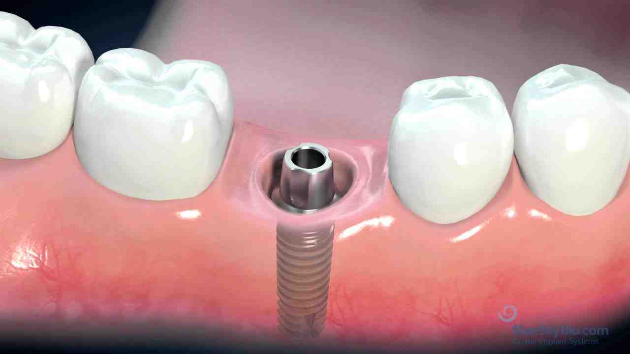 What are the steps in getting a dental implant?