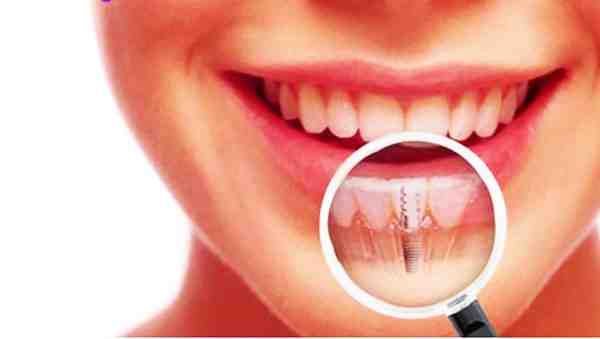 What can you not do after dental implant surgery?