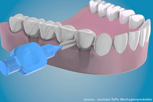 What can you not do after dental implants?