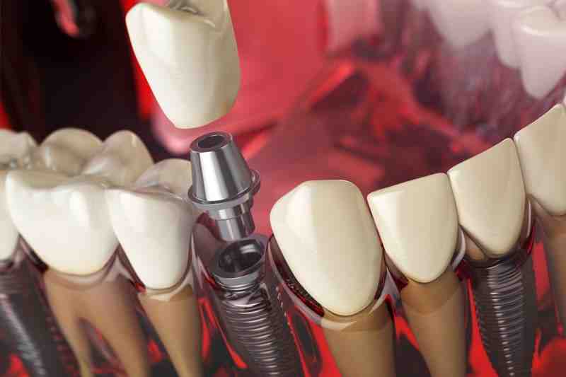 What dental implants should cost in 2020?