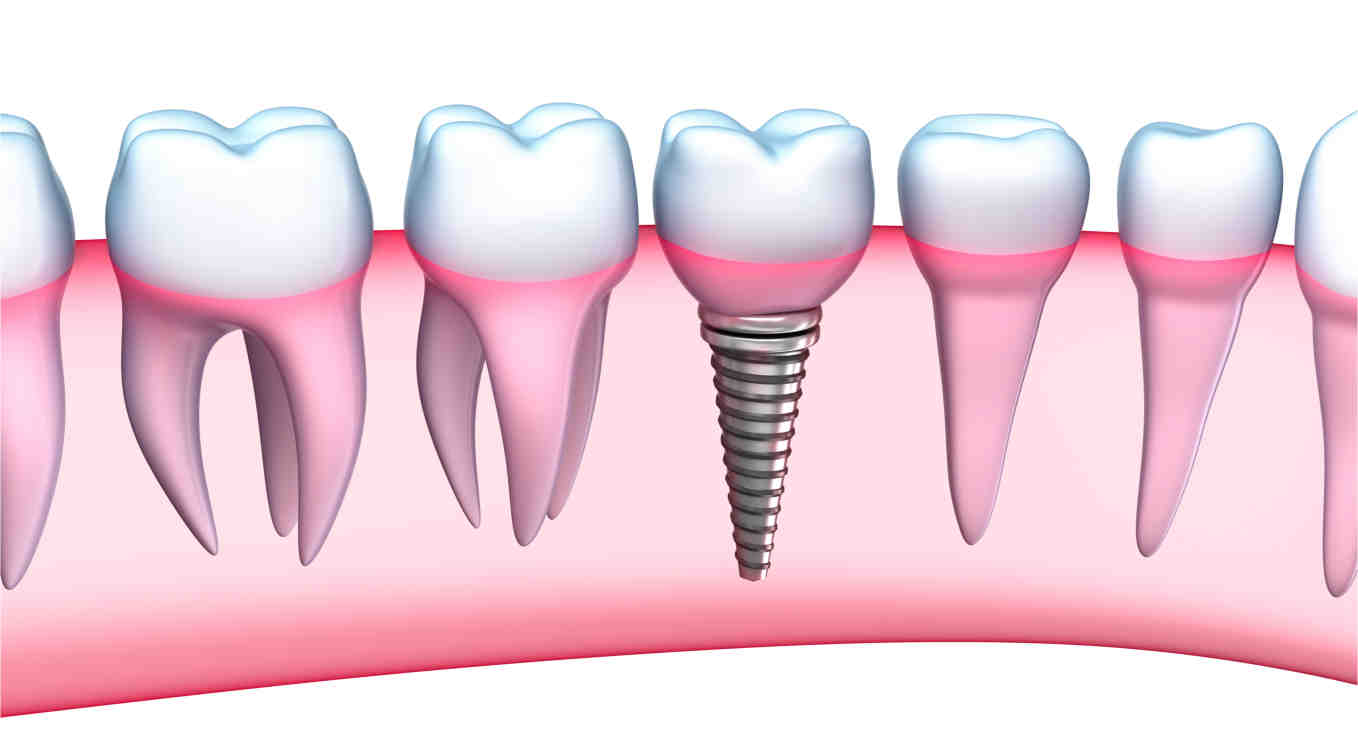 What dental insurance covers dental implants?