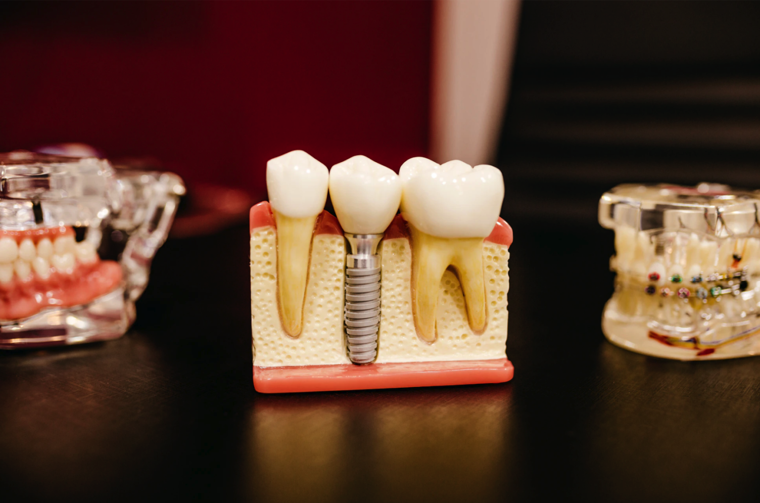 are-dental-implants-tax-deductible-dental-news-network